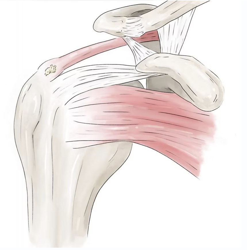 Calcification d'un tendon de la coiffe des rotateurs