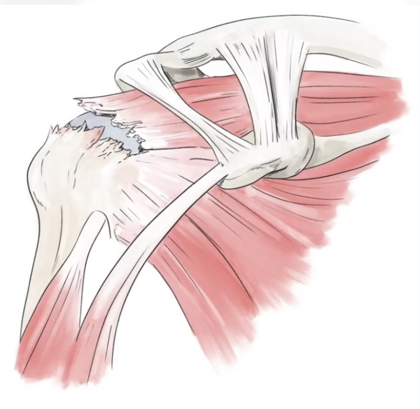 Rupture des tendons de la coiffe des rotateurs