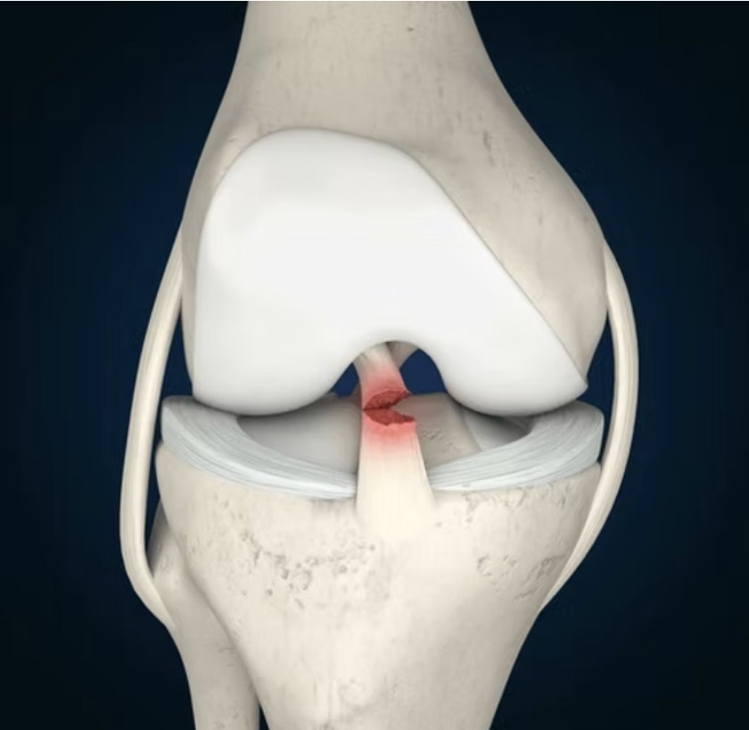 Rupture du ligament croisé antérieur